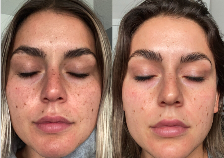 Pigmentation